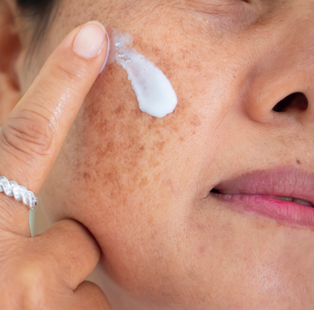 Melasma: saiba o que é, como tratar e prevenir